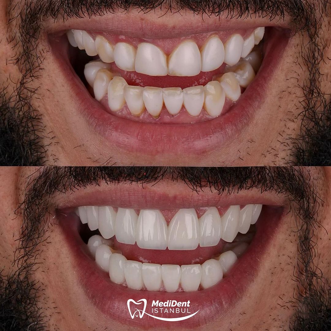 Dental İmplant